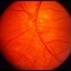 Extensive neovascularization of the disc